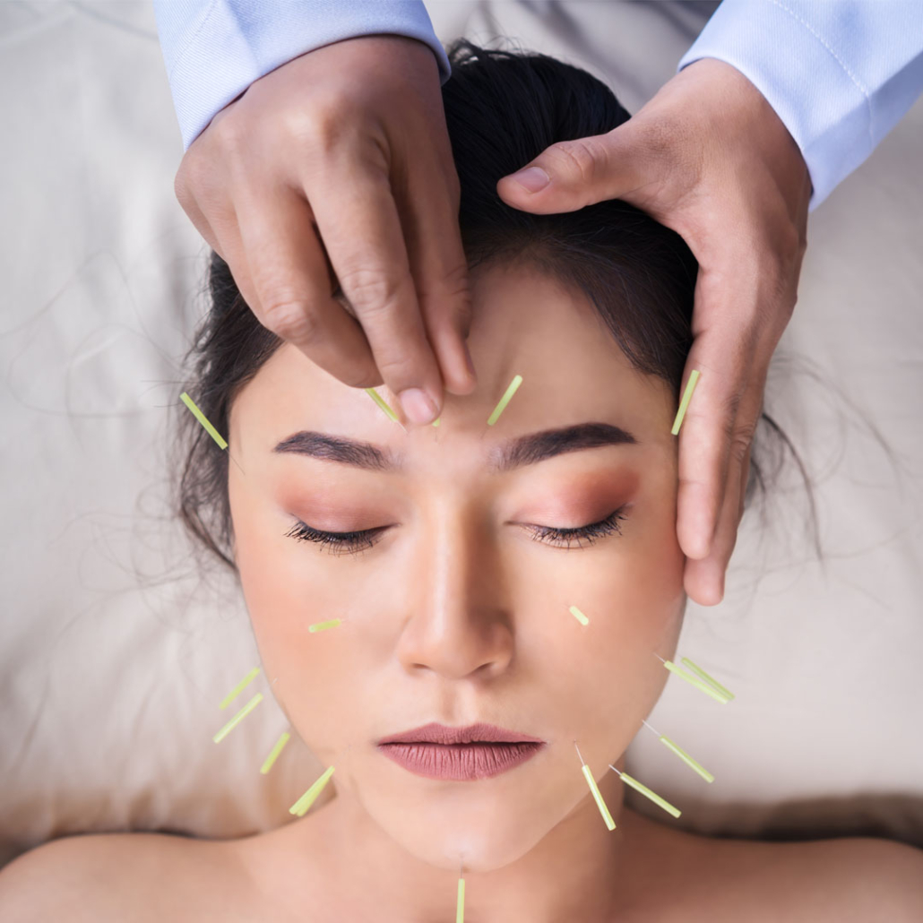 Women receiving acupuncture at Meridian Healthcare.
