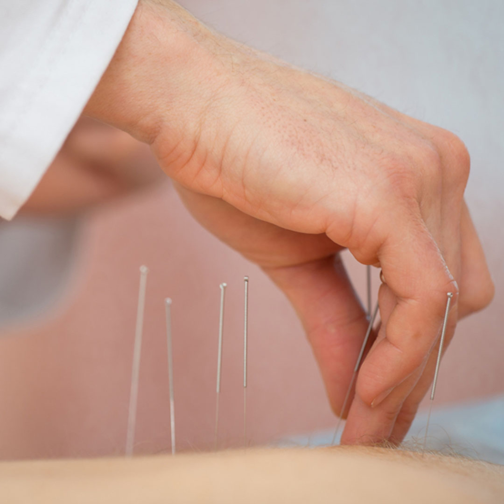 Doctor providing acupuncture treatment at Meridian Healthcare.